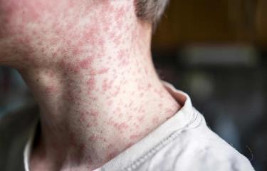 México intensifica la vacunación para frenar el brote de sarampión